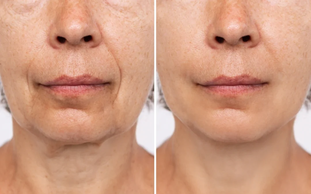 Rejuvenecimiento facial avanzado no invasivo