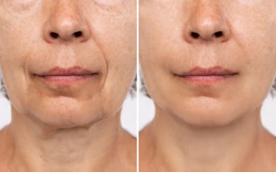 Rejuvenecimiento facial avanzado no invasivo