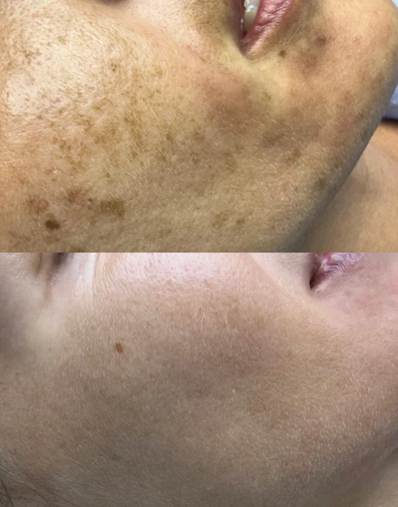 HIPERPIGMENTACIÓN - MELASMA TRATAMIENTO ANTES Y DESPUÉS EN CENTRO LÁSER MÉDICO TENERIFE