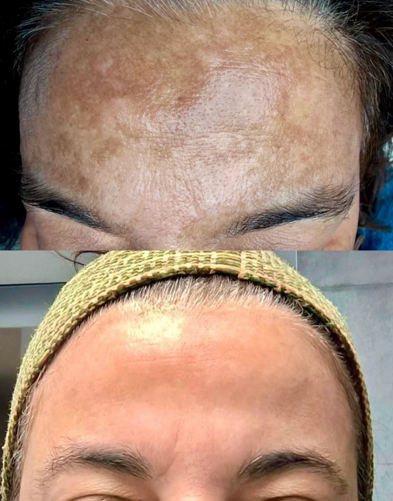 HIPERPIGMENTACIÓN - MELASMA TRATAMIENTO ANTES Y DESPUÉS EN CENTRO LÁSER MÉDICO TENERIFE